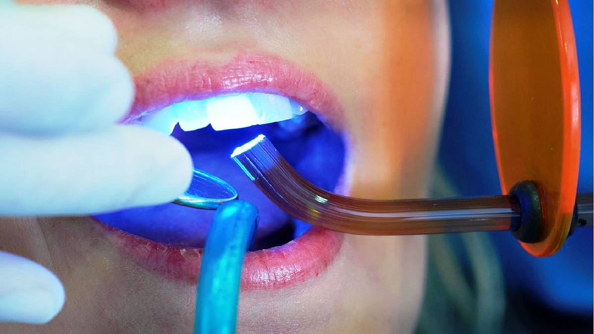 Лечение зуба - пломбирование каналов